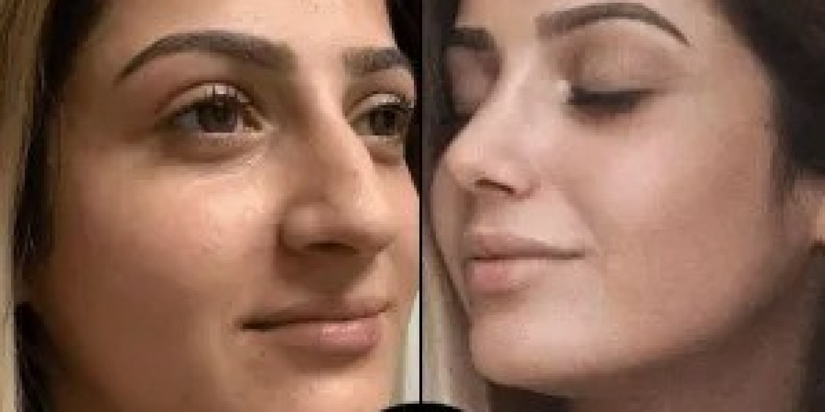 PRP treatment in Dubai restores skin health