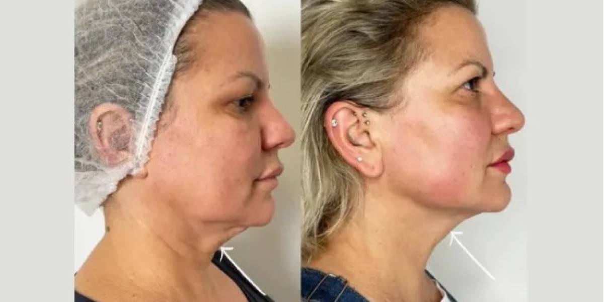 Best Plastic Surgeons in Dubai for Rhinoplasty and Nose Reshaping