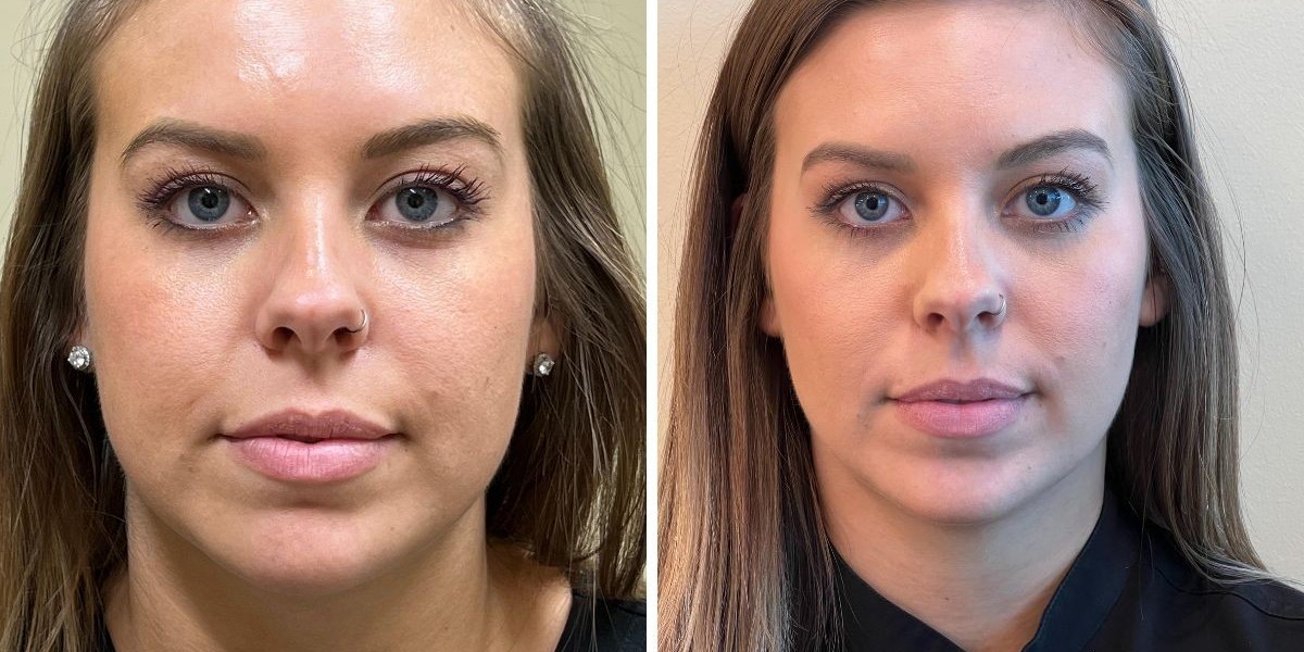 Jawline Botox Before and After: Subtle, Lasting Changes