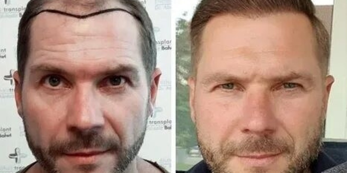 Hair Transplant in Islamabad – Restoring Confidence with Natural Results