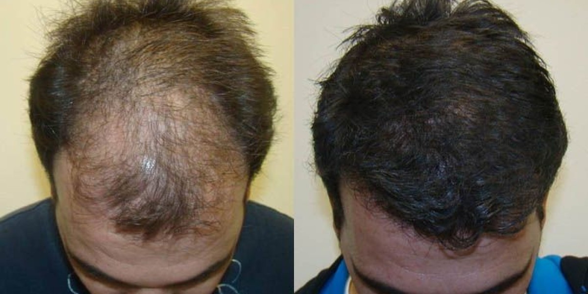 Why Is FUE Hair Transplant in Islamabad Becoming So Popular?