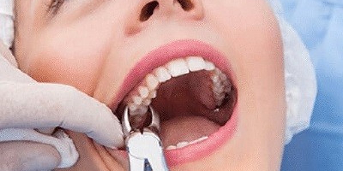 Simple vs. Surgical Extraction: What’s the Difference?