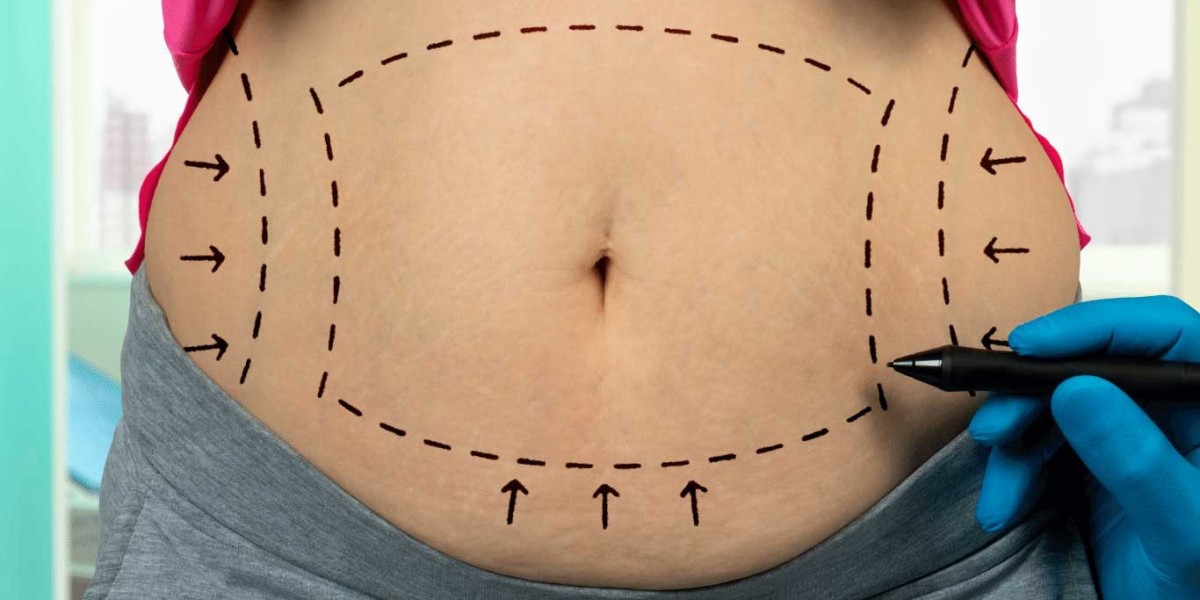 Reveal Your Best Shape with Abdominoplasty Islamabad