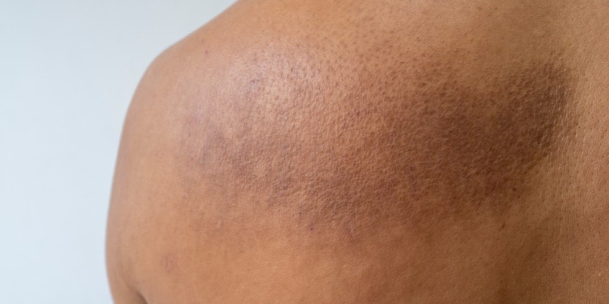 AL Amyloidosis Treatment Market Size & Forecast 2034