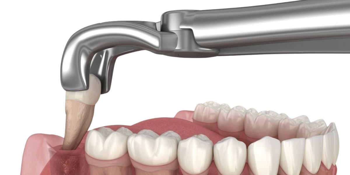 Dry Socket Prevention After Extraction in Islamabad – A Complete Guide