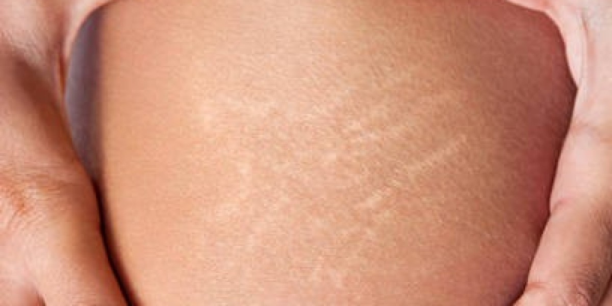 Stretch Mark Removal Treatments for Body Skin Renewal