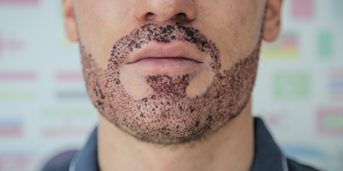 How Beard Hair Transplant in Islamabad Enhances Facial Shape